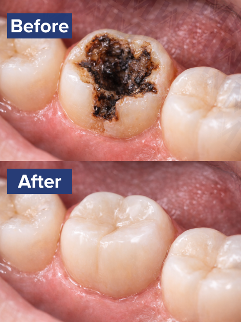 Dental Crown in turkey