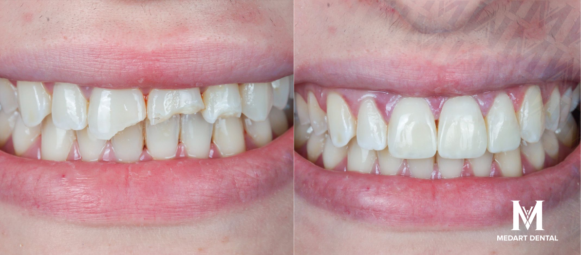 Dental crown before after