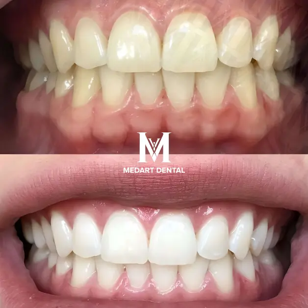 Teeth Whitening turkey