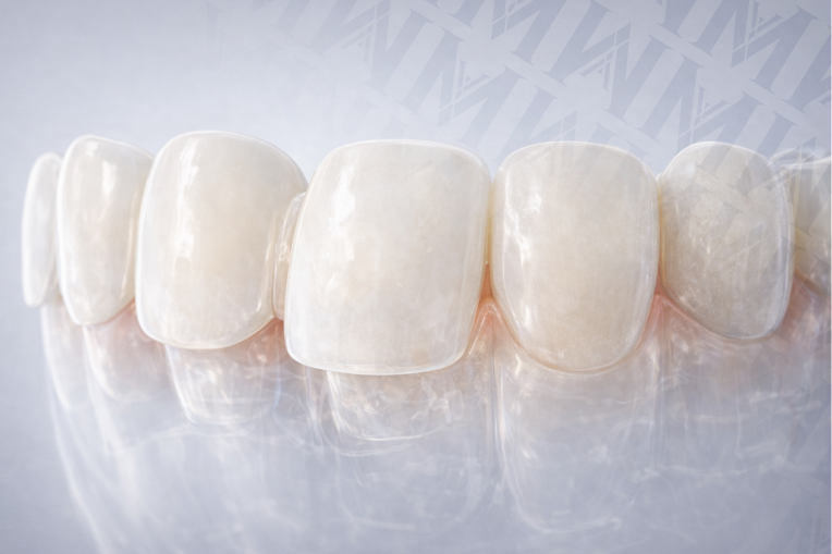 Veneers: Types, Costs, Procedure