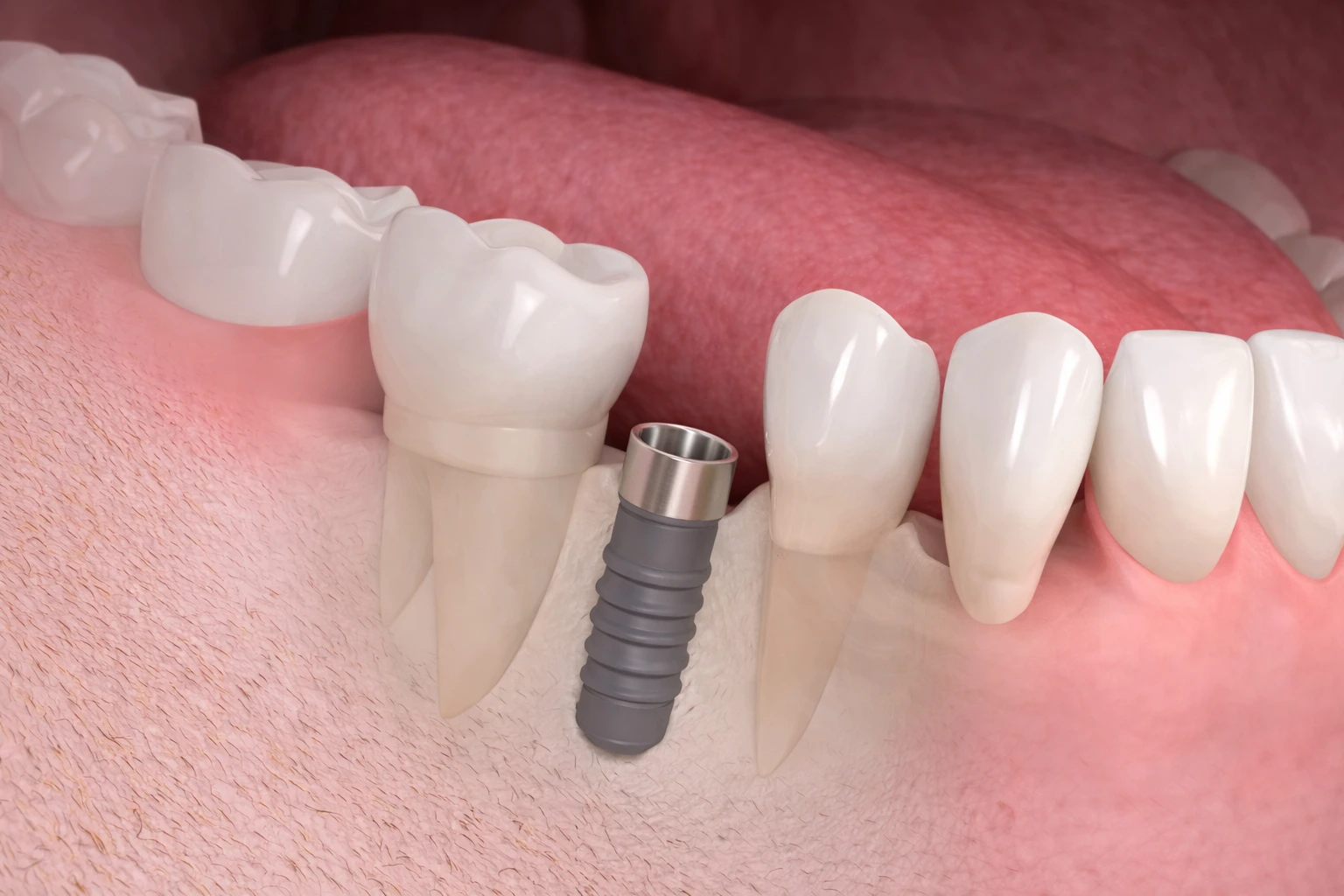 Dental Implant Turkey