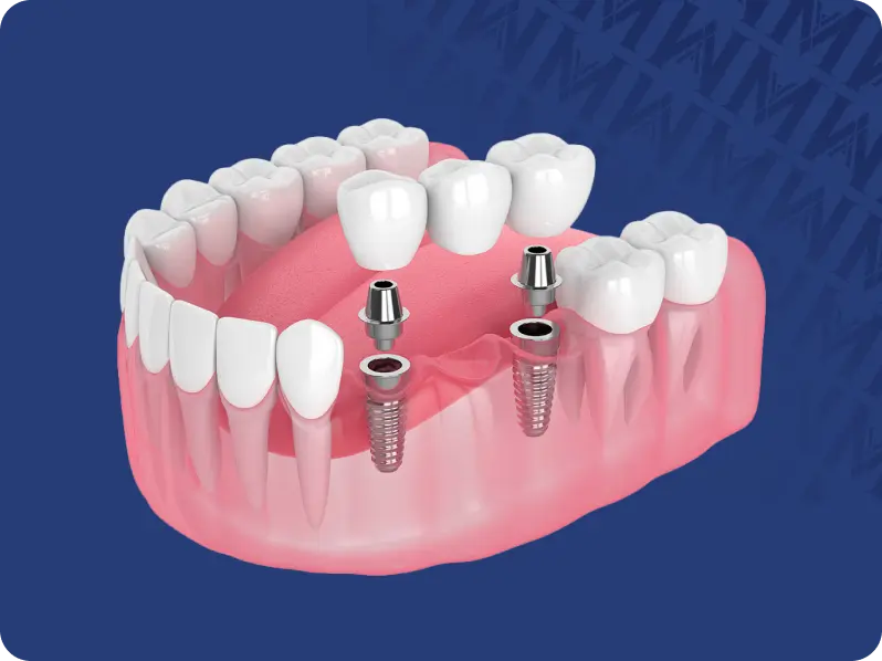 Complete Guide to Dental Implants